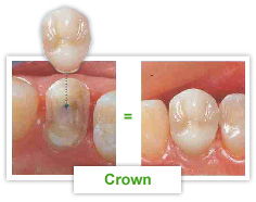 Restoration - Crown