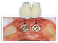 Procedures - Implant