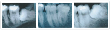 Procedures - Oral Surgery