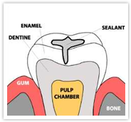 Fissure Sealant