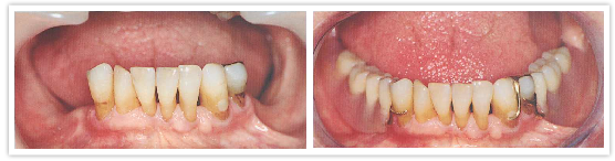 Prosedur - Dentur Prostetik