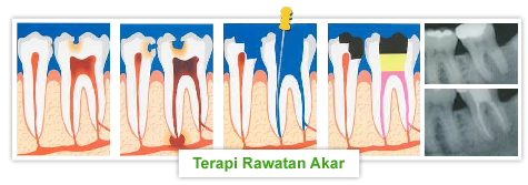 Prosedur - Endodontik - Terapi Rawatan Akar