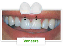 Restoration - Veneers